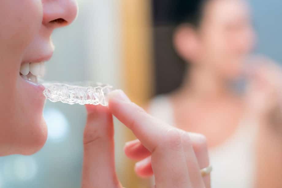 Top 5 Benefits of Clear Aligners